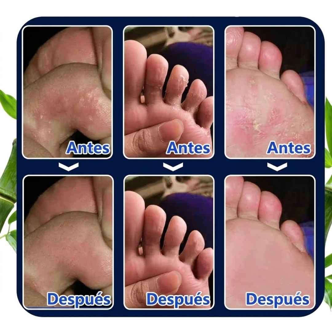 Tea Tree Oil – Antimicrobial Foot